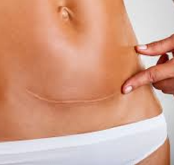 10 things you need to know about laparoscopic cyst/ovary removal